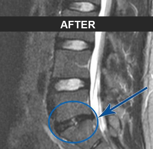 L5/S1 AFTER
