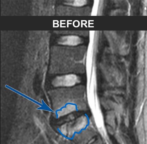 L5/S1 BEFORE