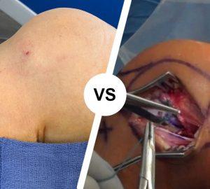 acl-surgery