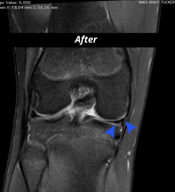 stem cell, acl
