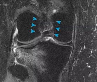 iobx stem cell treatment