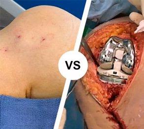 Knee Arthritis