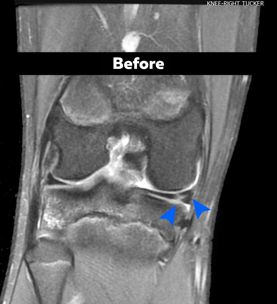 before stem cell acl treatment