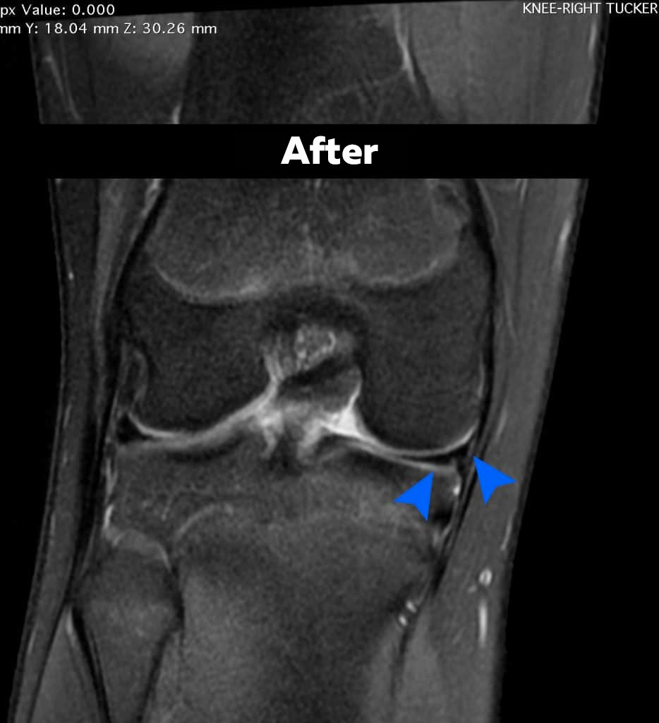 after before stem cell acl treatment